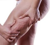I don’t like my cellulite