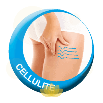Cellulite treatment diagram showing skin texture waves