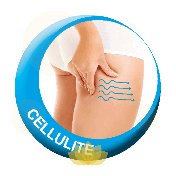 Cellulite treatment diagram showing skin texture waves