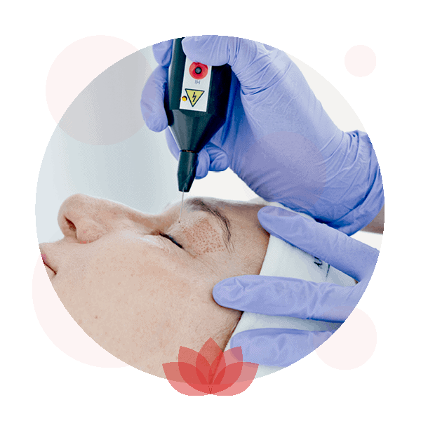 woman getting a blepharoplasty