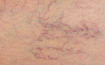 Can my spider vein legs be treated?
