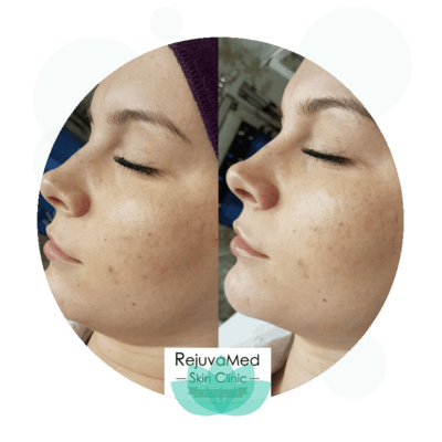 Before and after skin treatment comparison at RejuvaMed Skin Clinic