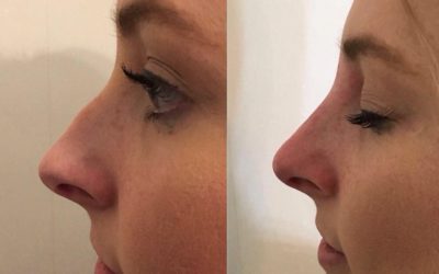 RejuvaMed Health & Wellness | New Year - New Nose! New Year – New Nose!
