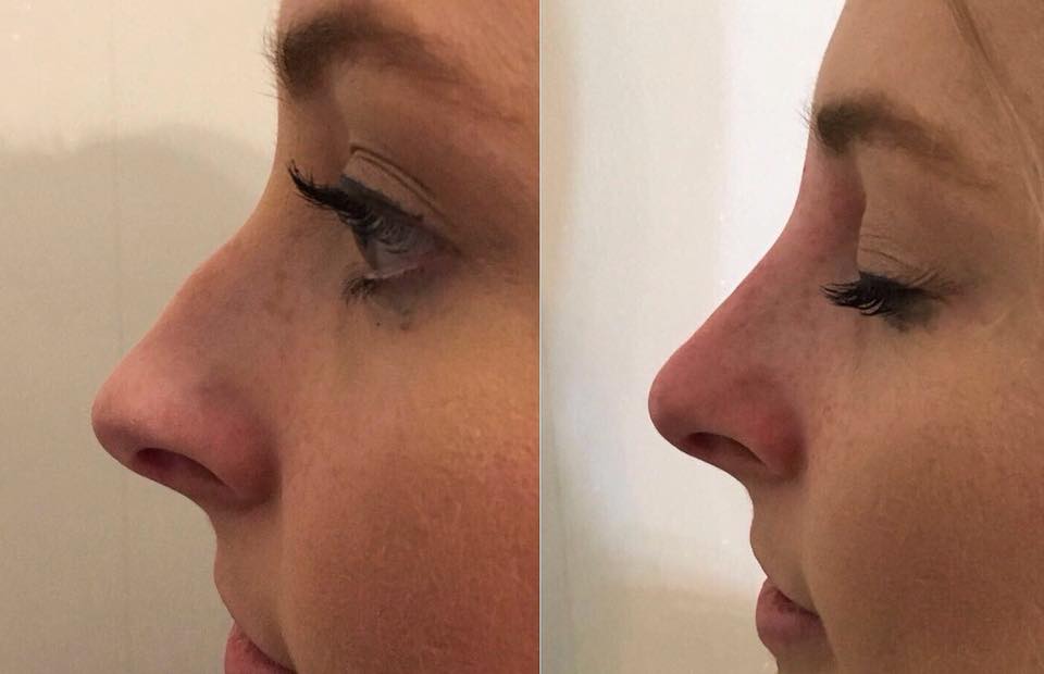 New Year – New Nose!