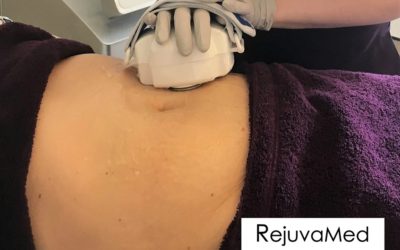 Cavitation – Instant inch loss body sculpting