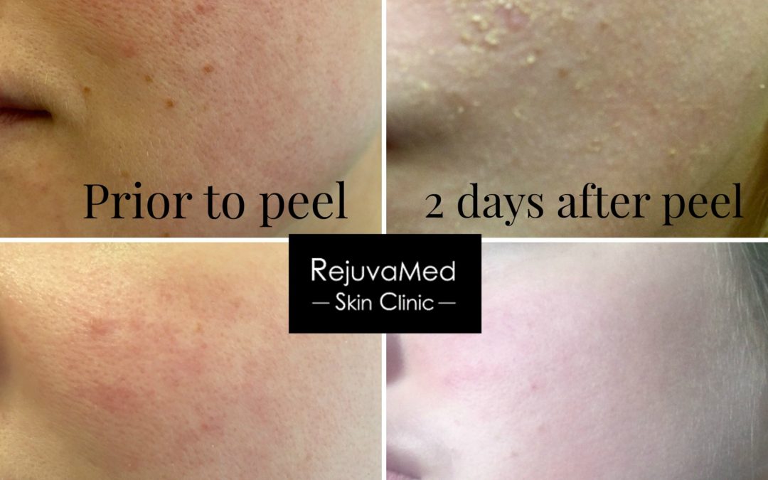 Peeling away the imperfections!