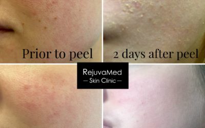 Peeling away the imperfections!