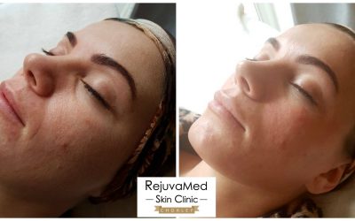 Dermaplaning – it’s all about shaving face!