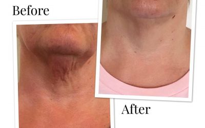 Profhilo – it’s the “necks” best thing! – Profhilo  Before And After Photos