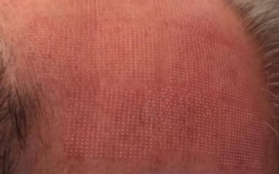 CO2 Laser Skin Resurfacing – Clitheroe clinic!
