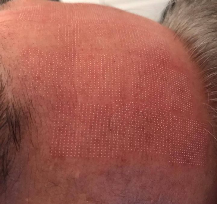 Close-up of scalp showing hair loss pattern and skin texture