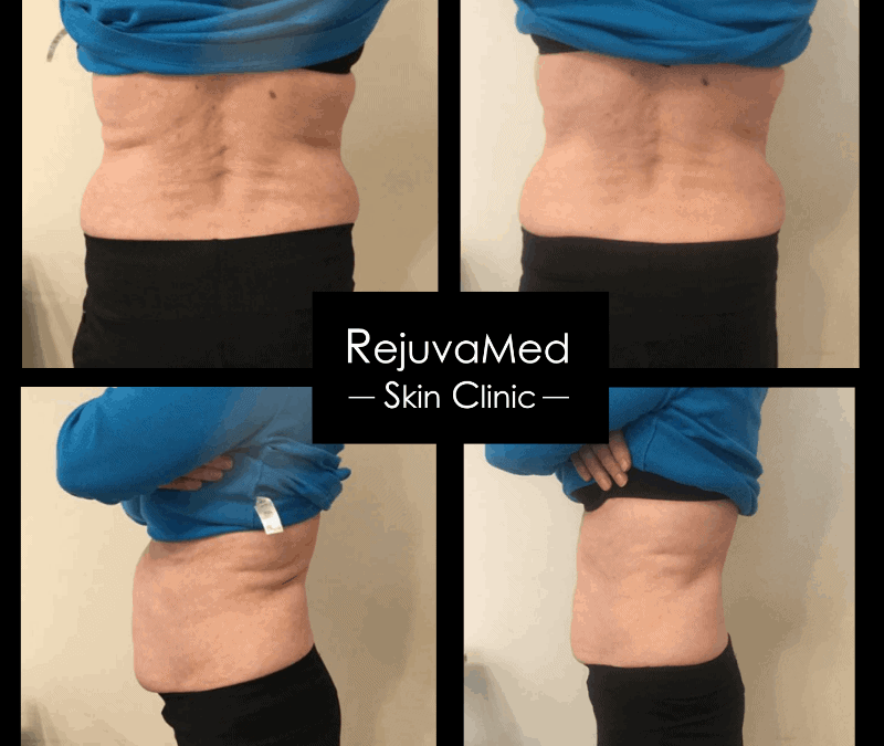 Before and after abdominal skin treatment results RejuvaMed