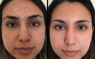 CO2 Laser Skin Resurfacing!