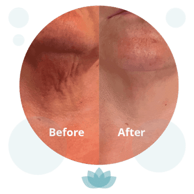 Before and after skin treatment comparison showing reduced redness