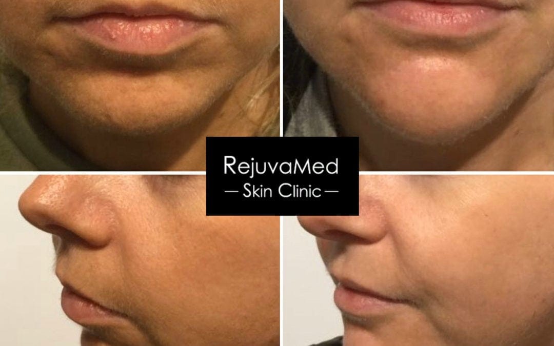 Before and after facial treatment results from RejuvaMed Skin Clinic