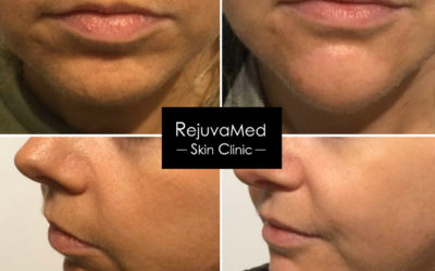 Dermal Fillers ~ Chin & Jawline Augmentation