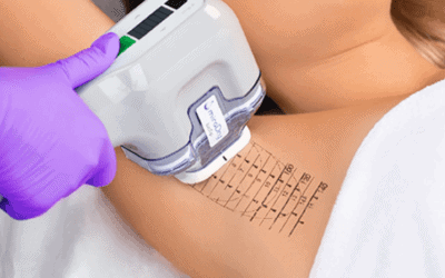 RejuvaMed Health & Wellness | Introducing miraDry for the treatment of underarm sweat! Introducing miraDry for the treatment of underarm sweat!