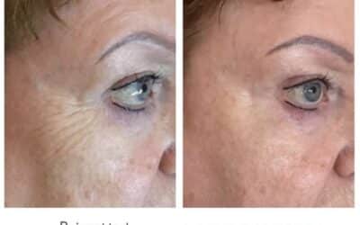 RejuvaMed Health & Wellness | We're seeing some amazing results with Morpheus8! We’re seeing some amazing results with Morpheus8!