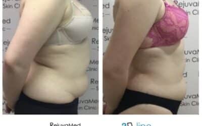 3D-Lipo Medical Grade Body Sculpting!