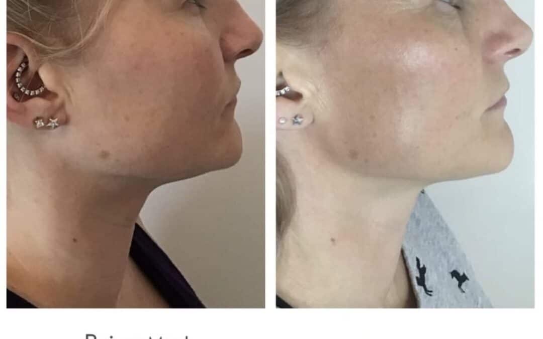 More amazing results for Morpheus8!