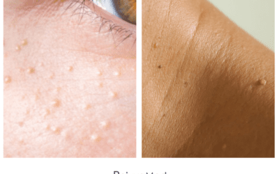 Skin Tag & Milia Removal Now Available!