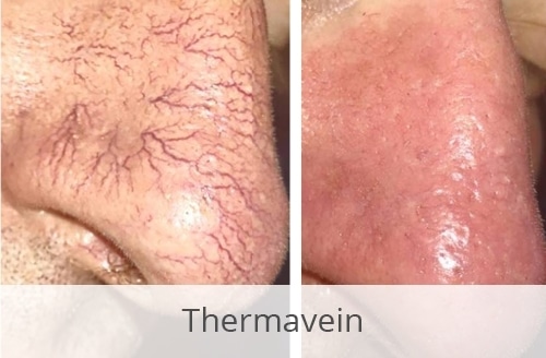 Thermavein before and after vein treatment comparison