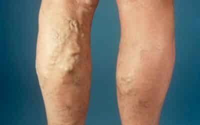 Am I at risk of getting varicose veins?
