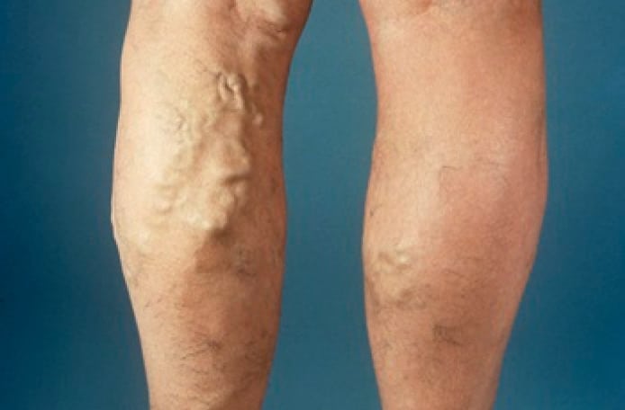 Male legs showing varicose veins comparison left right