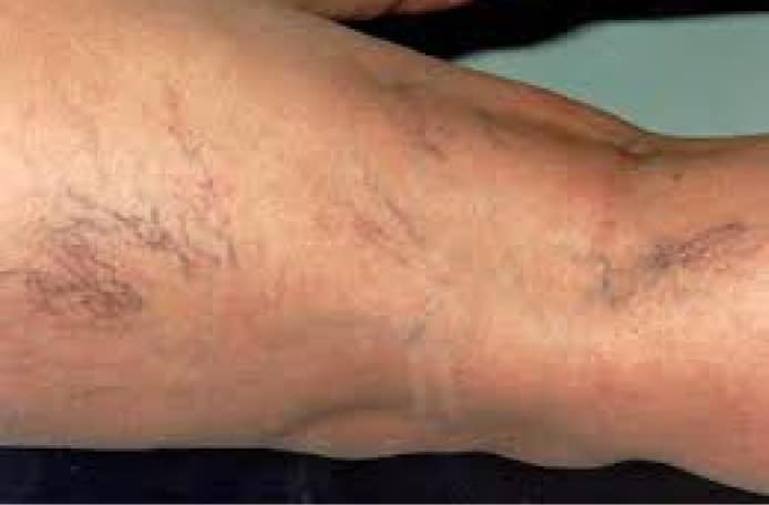 RejuvaMed Health & Wellness | Vein Treatments Forearm with varicose veins and visible vascular patterns