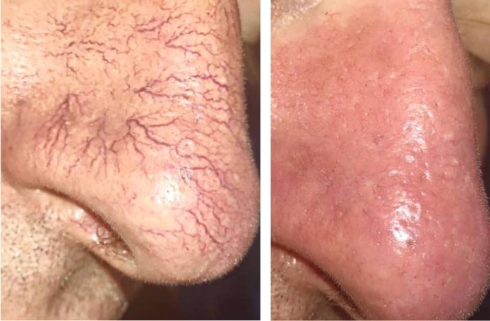 RejuvaMed Health & Wellness | Vein Treatments Before and after skin treatment comparison showing redness reduction