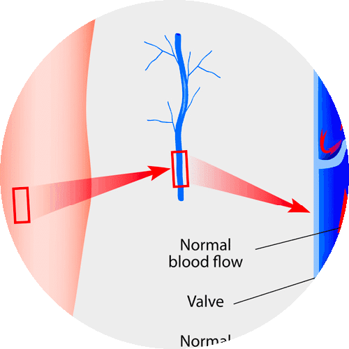 Diagram showing normal blood flow through heart valve