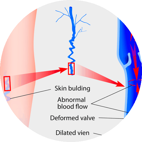 Medical diagram showing varicose vein formation causes