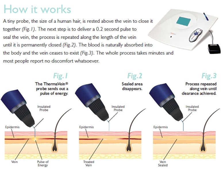 ThermaVein probe medical device procedure diagrams showing vein closure steps