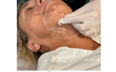 Deso Face for the treatment of a double chin