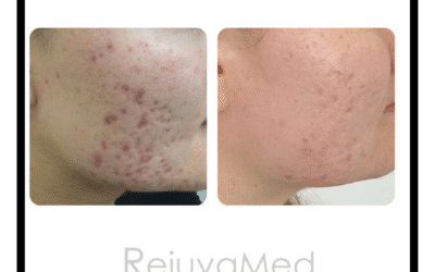 Patient progress – acne scarring treatment at RejuvaMed!