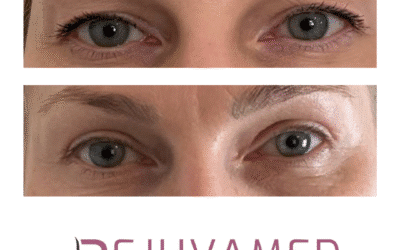 Eye-opening results for Upper Blepharoplasty!