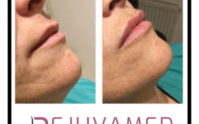 Natural looking lips are our speciality!