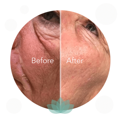 Skin treatment before and after comparison showing facial improvement