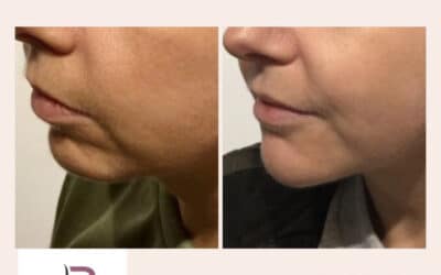 RejuvaMed Health & Wellness | Do you have a receding chin or jawline? Chin and jawline filler could help! Do you have a receding chin or jawline? Chin and jawline filler could help!