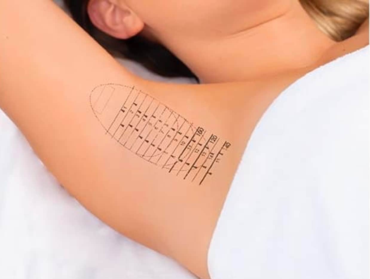 RejuvaMed Health & Wellness | MiraDry Sweat Treatment Skin patch test markings on person's arm