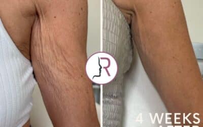 RejuvaMed Health & Wellness | Do you have crepey skin on your upper arms? Do you have crepey skin on your upper arms?
