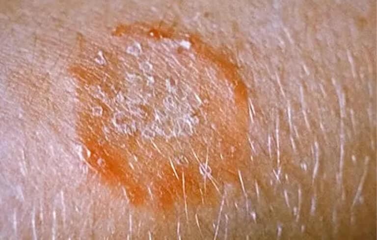 Skin wound with dried blood and scab formation