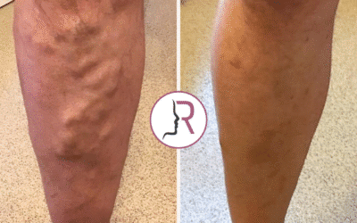 RejuvaMed Health & Wellness | Rediscover Confidence and Comfort with Varicose Vein Treatments at RejuvaMed! Rediscover Confidence and Comfort with Varicose Vein Treatments at RejuvaMed!