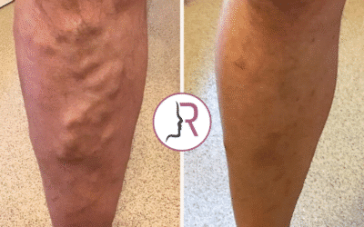 RejuvaMed Health & Wellness | How Can I Treat Varicose Veins Safely at a CQC Clinic in Lancashire? How Can I Treat Varicose Veins Safely at a CQC Clinic in Lancashire?