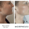 Morpheus8 Treatment Before and after skin treatment comparison profile view