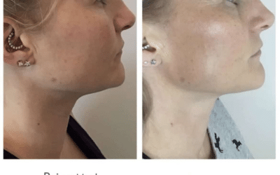 RejuvaMed Health & Wellness | Morpheus8 Treatment in Lancashire: Skin Tightening from Face to Body Morpheus8 Treatment in Lancashire: Skin Tightening from Face to Body
