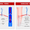 Varicose Veins – RejuvaMed Vein Centre – Clitheroe Lancashire Normal veins versus varicose veins medical comparison diagram